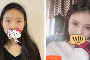 遵義醫(yī)科大學(xué)第五附屬（珠海）醫(yī)院整形燒傷手外科陳世玖整形價格表附全切雙眼皮案例展示