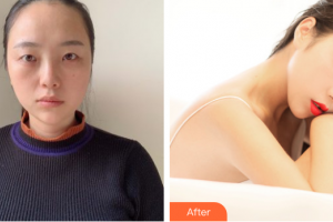 珠海雅媛醫(yī)療美容門診部張嘯整形價格表附眼部綜合案例展示