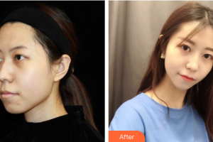 珠海藝星（原仁愛）醫(yī)療美容門診部梁勇整形價格表附光子嫩膚案例展示