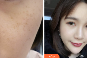 珠海美南華醫(yī)療美容醫(yī)院楊軍民整形價格表附超激光美膚祛斑案例展示