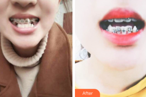 珠海美南華醫(yī)療美容醫(yī)院嚴(yán)擁整形價格表附金屬矯正案例展示