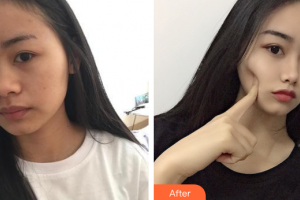 汕頭伊麗莎白整形美容醫(yī)院艾晶整形價格表附光子嫩膚案例展示