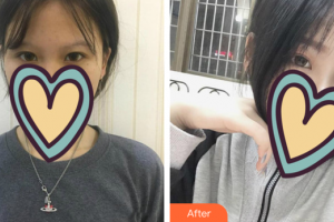 汕頭曙光整形美容醫(yī)院郭建濱整形價格表附眼部綜合案例展示