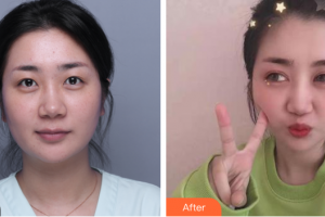 汕頭名流整形美容醫(yī)院李晶整形價格表附眼部整形案例展示