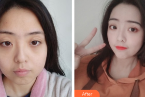 汕頭泛美泓涵醫(yī)療美容診所方曦環(huán)整形價格表附進(jìn)口針注射瘦臉瘦臉案例展示