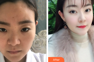 汕頭泛美泓涵醫(yī)療美容診所鄭少娜整形價格表附眼部手術(shù)案例展示