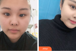 汕頭大學(xué)醫(yī)學(xué)院第一附屬醫(yī)院醫(yī)學(xué)美容中心紀(jì)影暢整形價格表附雙眼皮案例展示