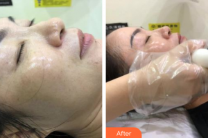 汕頭曙光整形美容醫(yī)院周麗整形價格表附玻尿酸精華導(dǎo)入案例展示