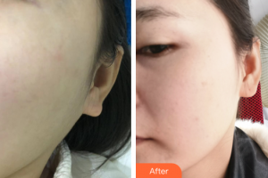 汕頭伊麗莎白整形美容醫(yī)院吳文玲整形價格表附光子嫩膚案例展示