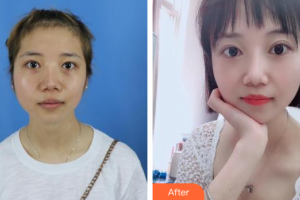 汕頭大學醫(yī)學院第一附屬醫(yī)院醫(yī)學美容中心蔡湘娜整形價格表附激光祛斑案例展示