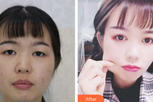 汕頭華美醫(yī)療美容醫(yī)院何斌整形價格表附切開雙眼皮案例展示