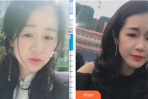 汕頭華美醫(yī)療美容醫(yī)院朱洙玉整形價格表附切開雙眼皮案例展示