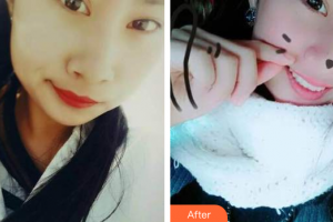 汕頭華美醫(yī)療美容醫(yī)院楊斌整形價格表附超聲波洗牙案例展示