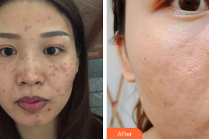 汕頭大學醫(yī)學院第二附屬醫(yī)院燒傷整形科唐世杰整形價格表附去痘印痘坑案例展示