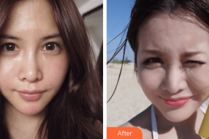 汕頭大學醫(yī)學院第二附屬醫(yī)院燒傷整形科李海紅整形價格表附祛斑案例展示