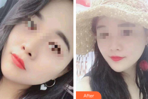 汕頭大學醫(yī)學院第二附屬醫(yī)院燒傷整形科楊旅軍整形價格表附超微小氣泡案例展示