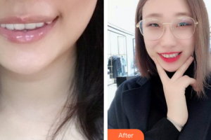 汕頭邱寧口腔診所陳曉發(fā)整形價格表附隱形矯正案例展示