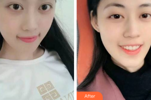 汕頭邱寧口腔診所邱寧整形價格表附瓷貼面案例展示