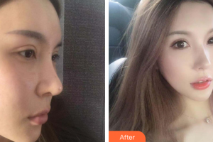 佛山曙光金子醫(yī)學美容醫(yī)院甘國端整形價格表附光子嫩膚案例展示