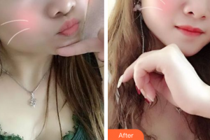 佛山亞韓整形美容門診部時安平整形價格表附紅藍光祛痘案例展示