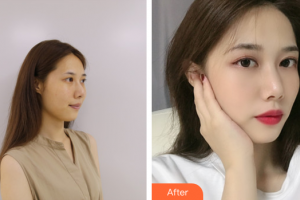 佛山曙光金子醫(yī)學美容醫(yī)院鄭永健整形價格表附玻尿酸精華導入案例展示