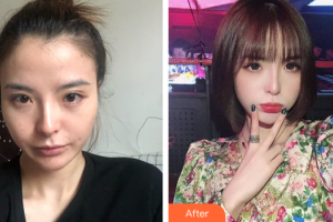 佛山曙光金子醫(yī)學美容醫(yī)院劉洲尉整形價格表附面部吸脂案例展示