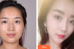 佛山曙光金子醫(yī)學美容醫(yī)院沈荷云整形價格表附美白嫩膚案例展示