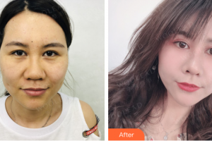 佛山曙光金子醫(yī)學美容醫(yī)院邱會銀整形價格表附超激光美膚案例展示