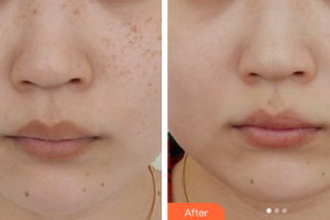 佛山曙光金子醫(yī)學美容醫(yī)院甘廣蓮整形價格表附激光祛除雀斑案例展示