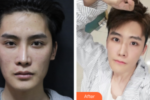 佛山瑞芙臣夢露醫(yī)學整形美容醫(yī)院陸小湖整形價格表附超激光美膚祛斑案例展示