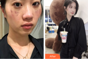 佛山市第一人民醫(yī)院醫(yī)學美容科劉必來整形價格表附祛斑案例展示