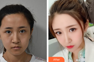 佛山市第一人民醫(yī)院醫(yī)學美容科楊榮梅整形價格表附二氧化碳點痣案例展示