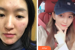 佛山市第一人民醫(yī)院醫(yī)學美容科黎詠璇整形價格表附微針美膚案例展示