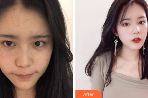 佛山市第二人民醫(yī)院醫(yī)學整形美容科張旭霞整形價格表附光子嫩膚案例展示