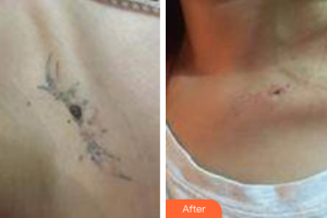 佛山南海區(qū)第二人民醫(yī)院燒傷整形科梁振潮整形價格表附洗紋身案例展示