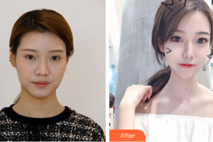 佛山黛顏人醫(yī)療美容門(mén)診部胡斌整形價(jià)格表附多方面部埋線(xiàn)提升案例展示