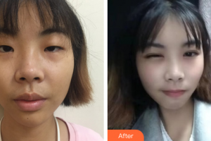 山東省千佛山醫(yī)院整形外科趙悅整形價格表附眼部綜合案例展示