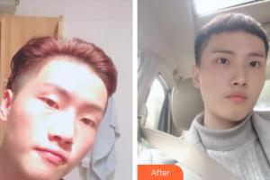 山東省千佛山醫(yī)院整形外科劉瑞鳴整形價(jià)格表附雙眼皮案例展示