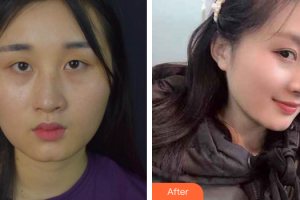 山東省千佛山醫(yī)院整形外科王彥整形價(jià)格表附切開(kāi)雙眼皮案例展示