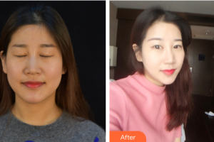 佛山蘇李秀英醫(yī)院激光整形科劉曉玉整形價(jià)格表附熱瑪吉案例展示