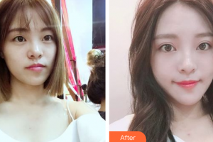 佛山曙光金子醫(yī)學(xué)美容醫(yī)院夏令芳整形價(jià)格表附眼部整形案例展示