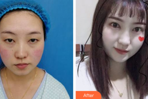 佛山廣美醫(yī)療美容門(mén)診部王文整形價(jià)格表附眼部手術(shù)案例展示