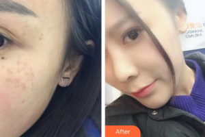 佛山壹加壹瑪麗婭整形美容醫(yī)院凌玲整形價(jià)格表附超激光美膚祛斑案例展示