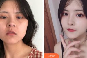 佛山華美整形美容醫(yī)院雷朝勇整形價(jià)格表附假體隆鼻案例展示