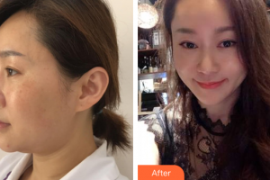 佛山壹加壹瑪麗婭整形美容醫(yī)院袁抒懷整形價(jià)格表附面部輪廓案例展示