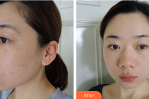 佛山瑞芙臣?jí)袈夺t(yī)學(xué)整形美容醫(yī)院DelarivePatricia整形價(jià)格表附AOPT祛斑去痘印案例展示