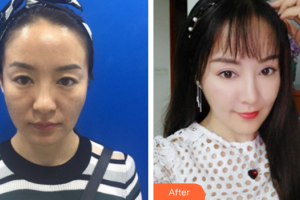 佛山貝爾美醫(yī)學(xué)美容整形醫(yī)院陳海燕整形價(jià)格表附埋線(xiàn)提升案例展示