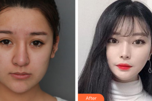 佛山瑞芙臣?jí)袈夺t(yī)學(xué)整形美容醫(yī)院李斌整形價(jià)格表附鼻部綜合案例展示