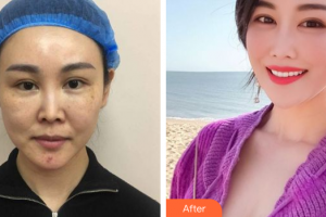 佛山瑞芙臣?jí)袈夺t(yī)學(xué)整形美容醫(yī)院SarahKim整形價(jià)格表附埋線(xiàn)提升案例展示