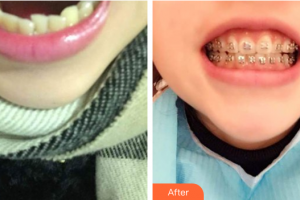 佛山曙光金子醫(yī)學(xué)美容醫(yī)院潘遜玲整形價(jià)格表附金屬矯正案例展示